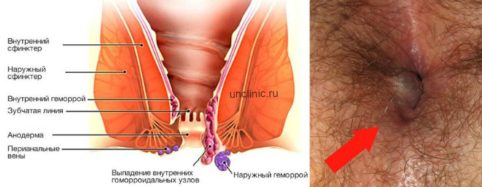 Стадии геморроя - симптомы, признаки и лечение 1, 2, 3 и 4 стадии